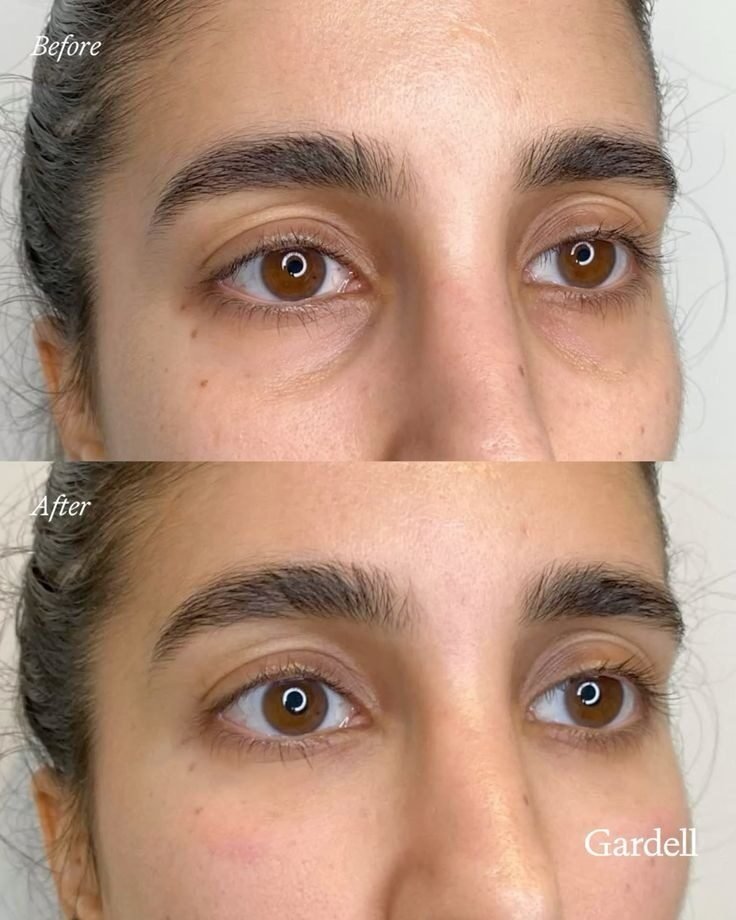 Under-eye treatment result at Syinger Aesthetics