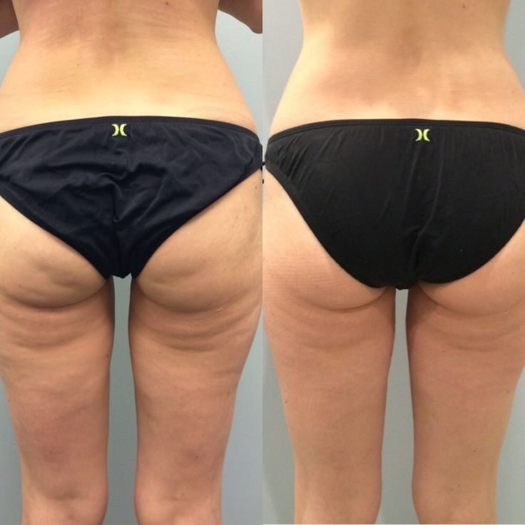 Body contouring result at Syinger Aesthetics