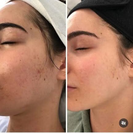 Treatment result at Syinger Aesthetics