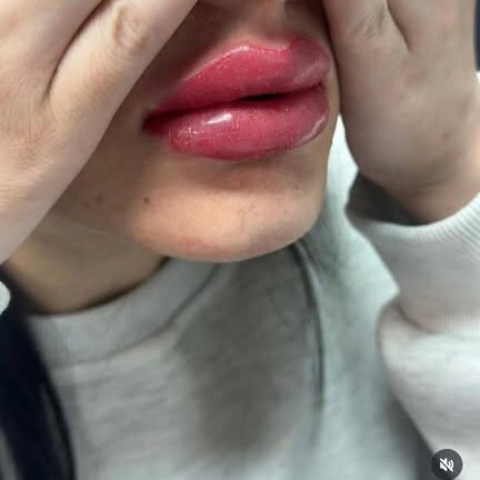 Treatment result at Syinger Aesthetics