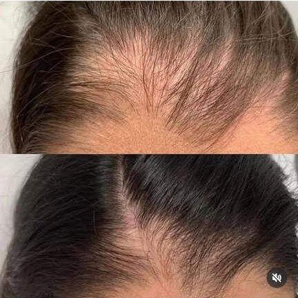 Treatment result at Syinger Aesthetics