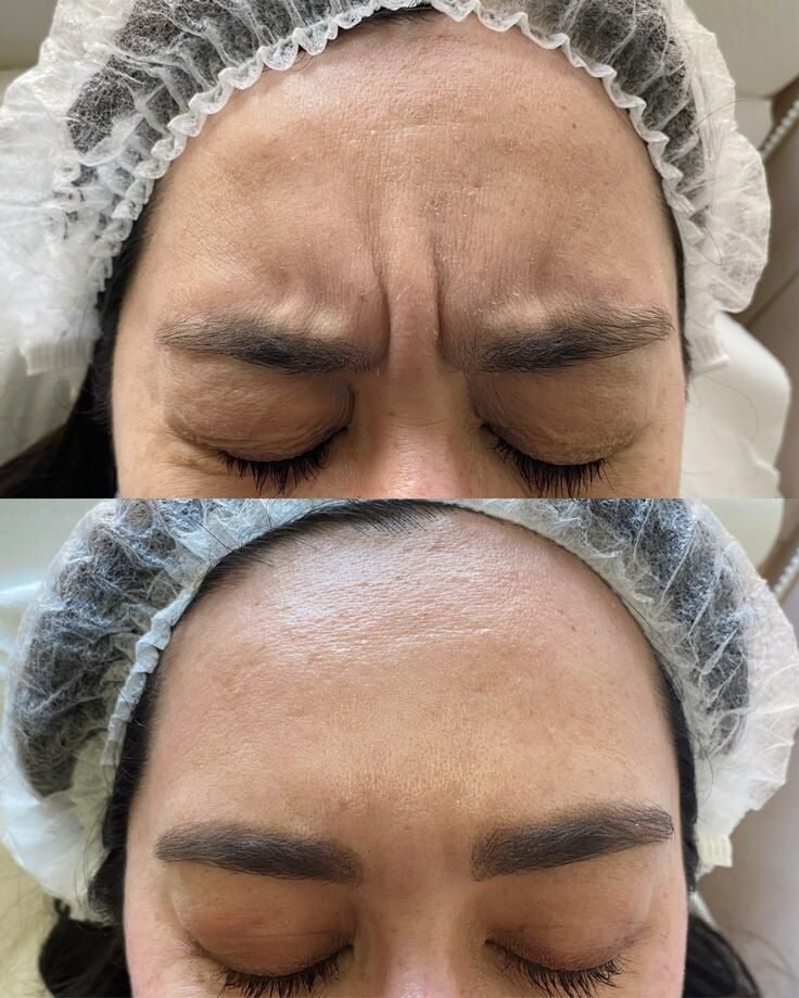 Forehead treatment result at Syinger Aesthetics