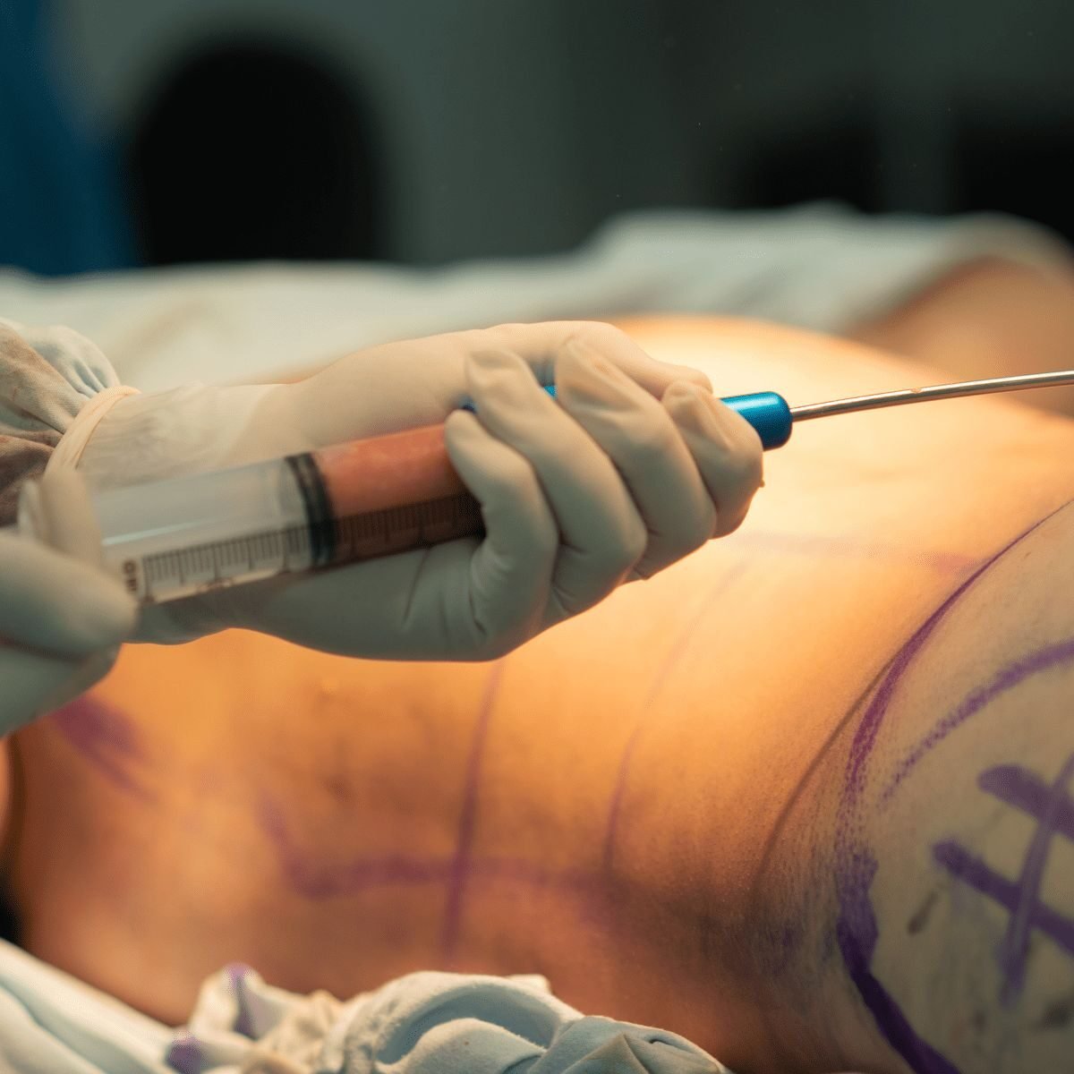 Skin treatment at Syinger Aesthetics
