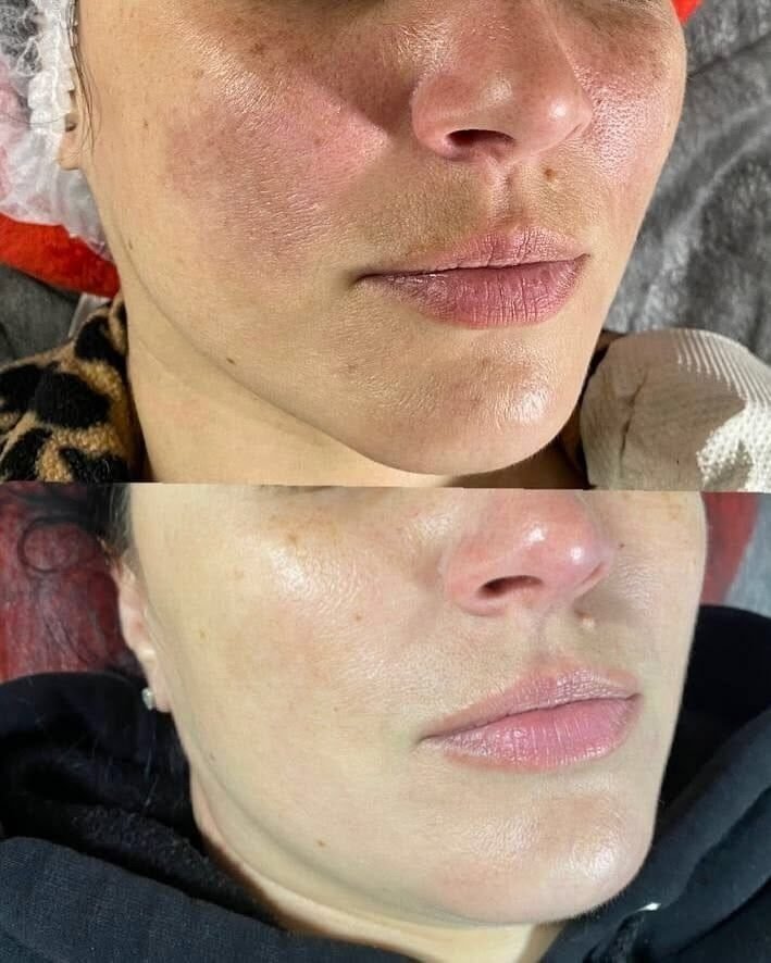 Acne treatment result at Syinger Aesthetics